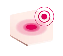 Icon Errötung und Schwellung der Haut