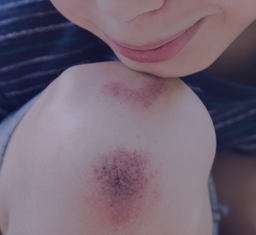 Schürfwunde auf dem Knie eines Kindes